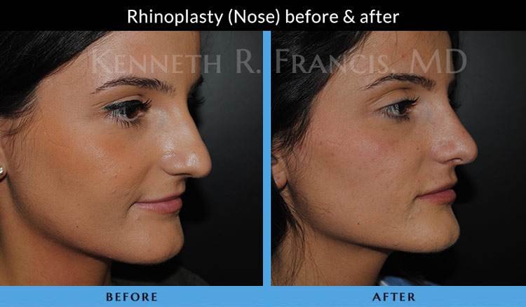 Rhinoplasty (Nose) before and after
