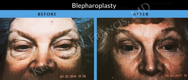 blepharoplasty before after