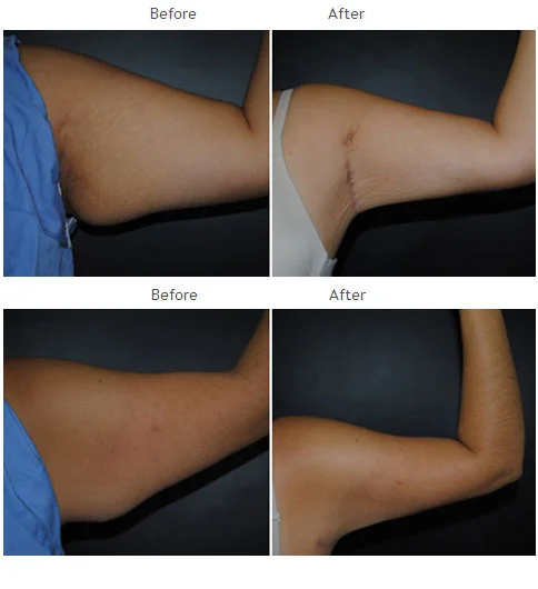 Arm lift before and after