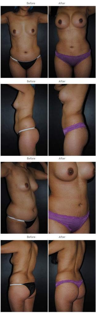 Mommy makeover before and after 6 Mommy Makeover