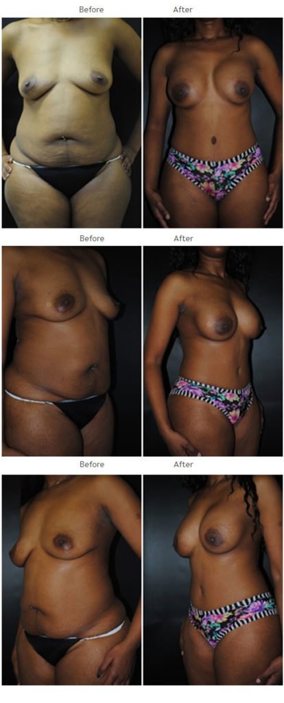 Mommy makeover before and after 5 Mommy Makeover