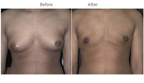 Gynecomastia