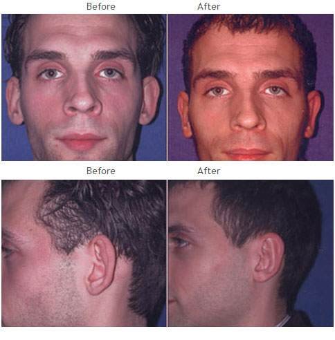 Otoplasty Facial-ear