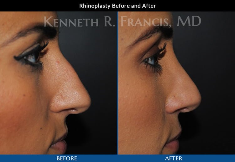 Rhinoplasty (Nose) before and after