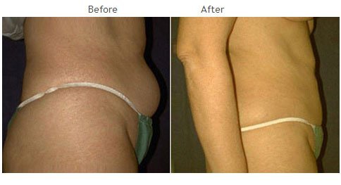 Liposuction NYC Case 1007