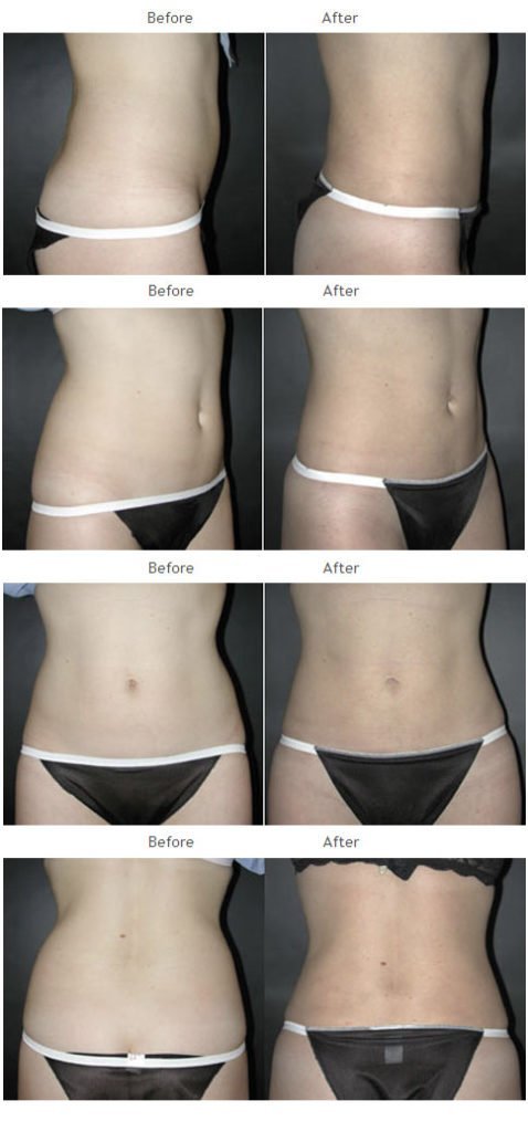 Liposuction NYC Case 1009