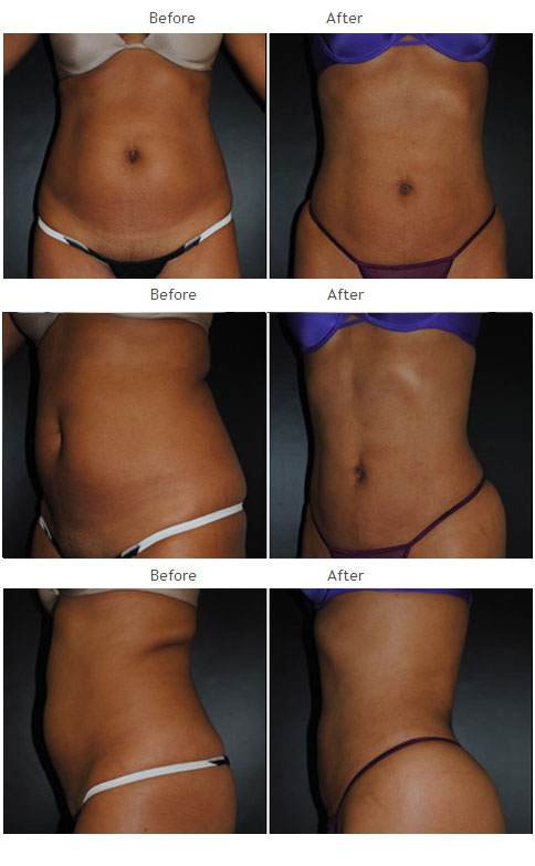 Liposuction NYC Case 1010