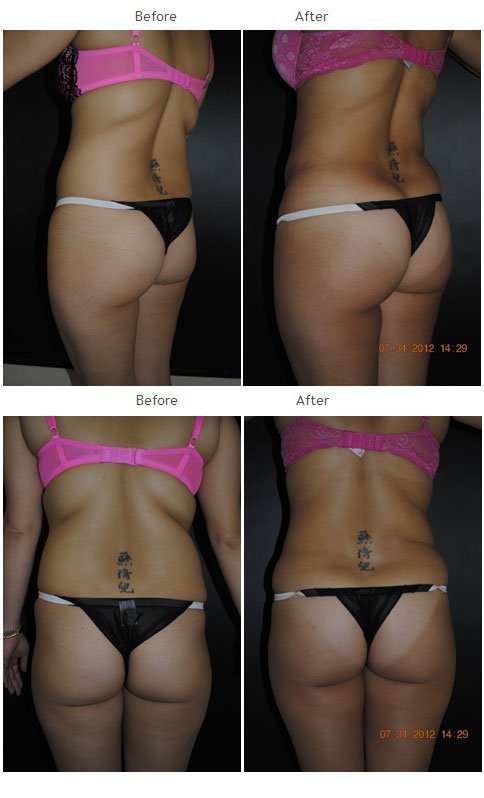 Liposuction NYC Case 1011