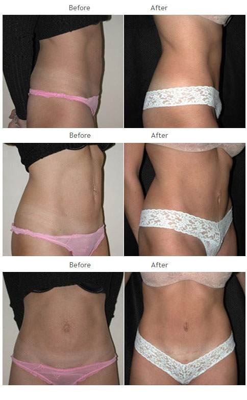 Case 1014 Tummy Tuck