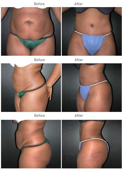 Case 1016 Tummy Tuck