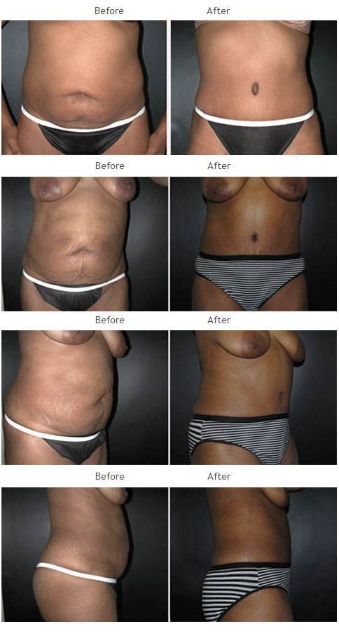 Case 1017 Tummy Tuck