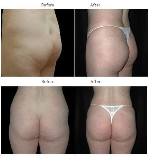 Brazilian Butt Lift NYC Case 1024