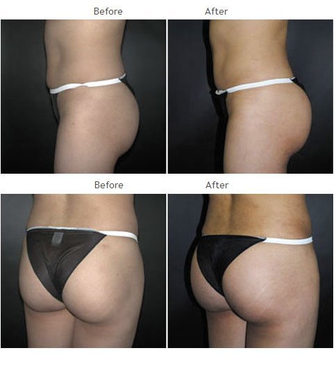Brazilian Butt Lift NYC Case 1030