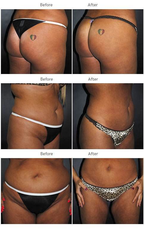 Brazilian Butt Lift NYC Case 1031