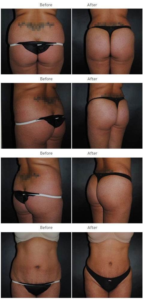 Brazilian Butt Lift NYC Case 1034