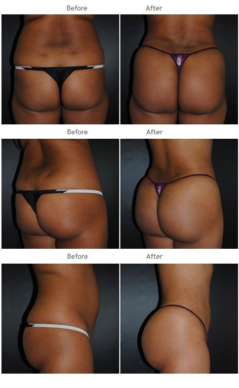 Brazilian Butt Lift NYC Case 1040