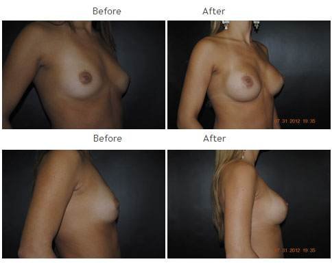 Breast augmentation before and after 26 Breast Augmentation NYC Case 1043