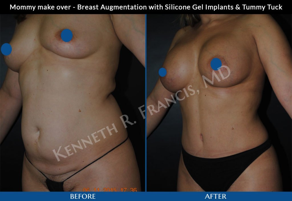 Mommy makeover before and after 4 Mommy make over - Breast Augmentation with Silicone Gel Implants & Tummy Tuck