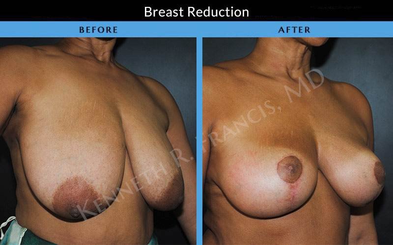 breast reduction before after