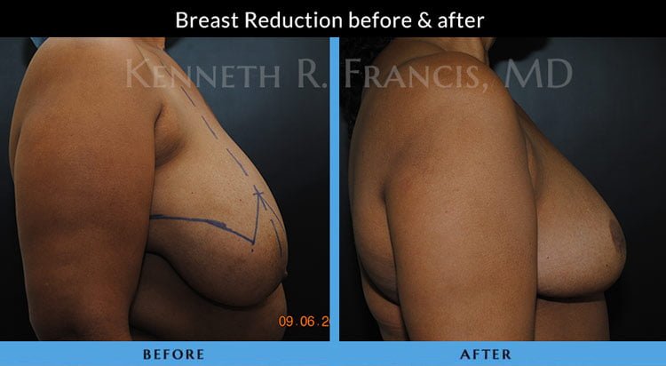 Breast Reduction NYC Case 1072