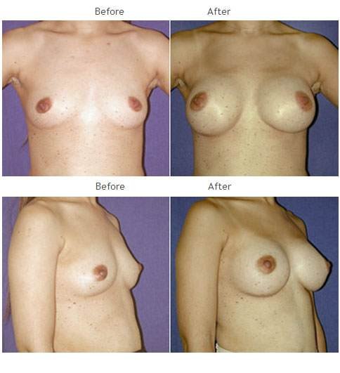 Breast augmentation before and after 30 breast augmentation NYC