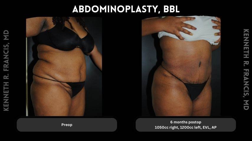Abdominoplasty, BBL
