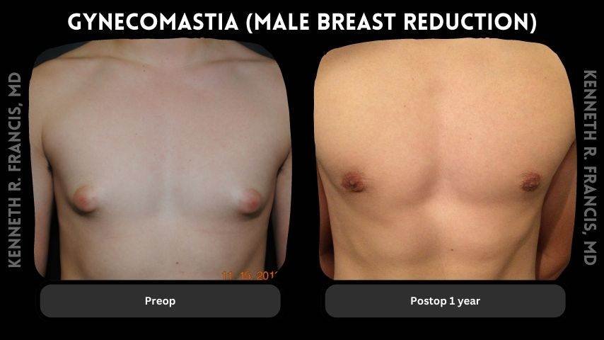 Gynecomastia (Male Breast Reduction)