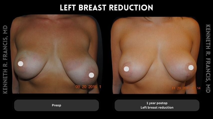 Left breast reduction