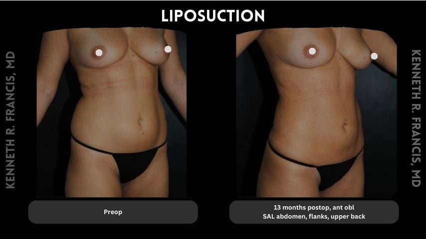 Liposuction