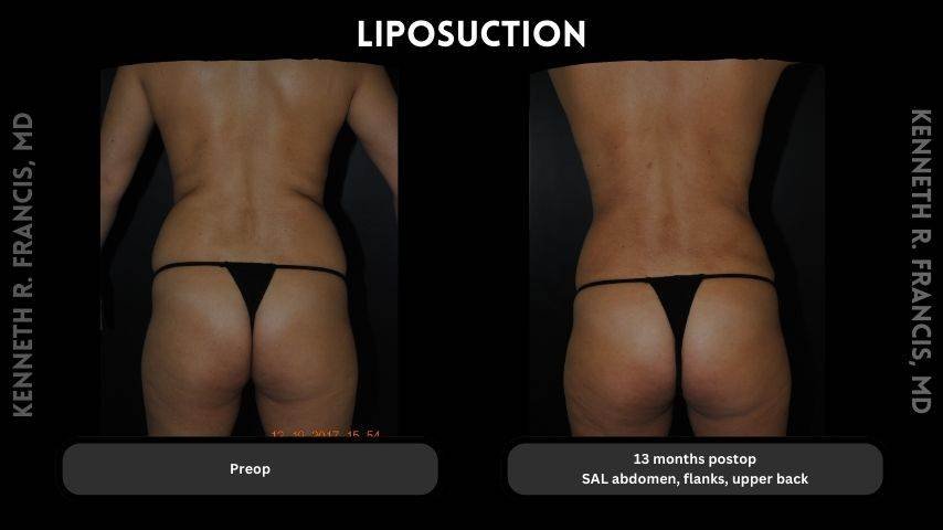 Liposuction
