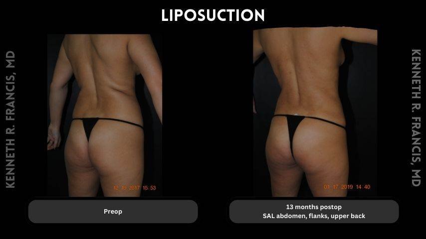 Liposuction