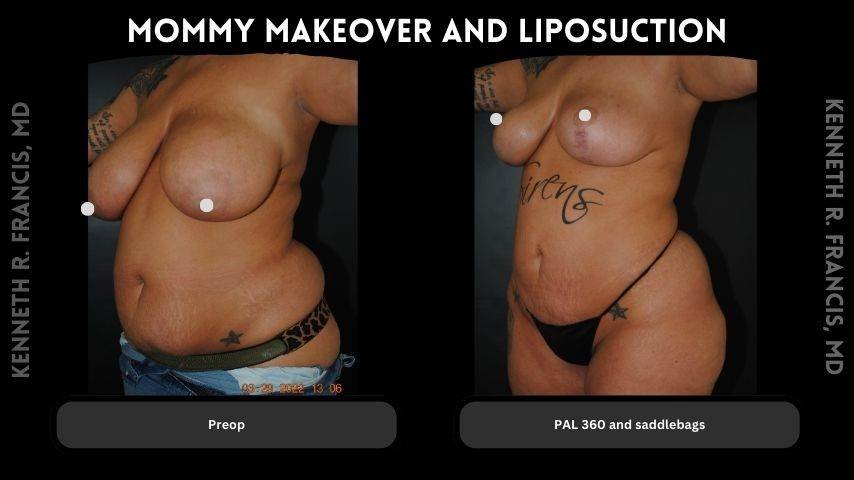 Mommy makeover before and after 3 mommy makeover and Liposuction