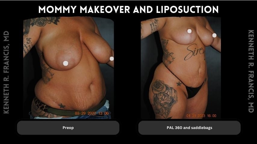 Mommy makeover before and after 1 mommy makeover and Liposuction