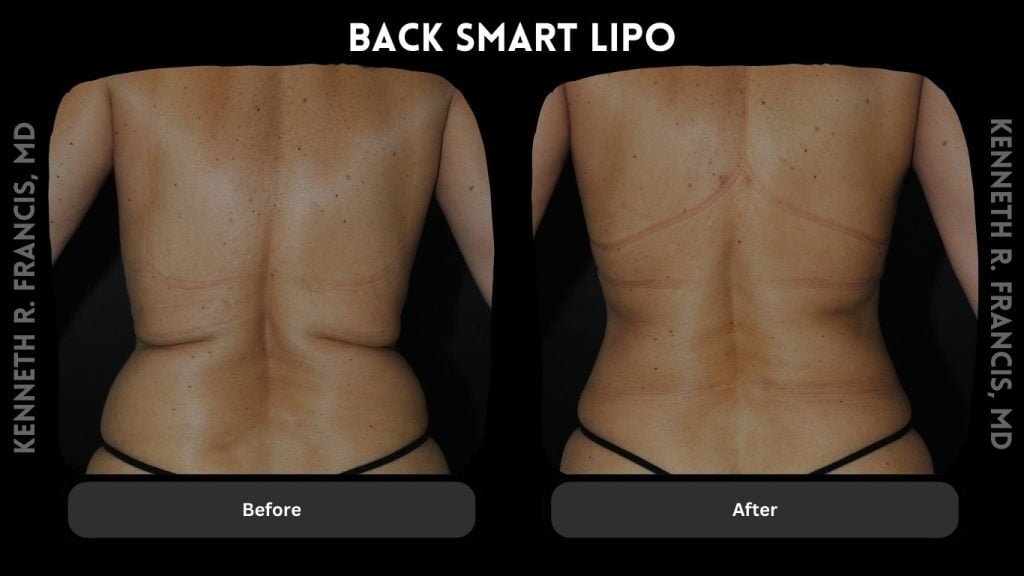 back smart lipo NYC