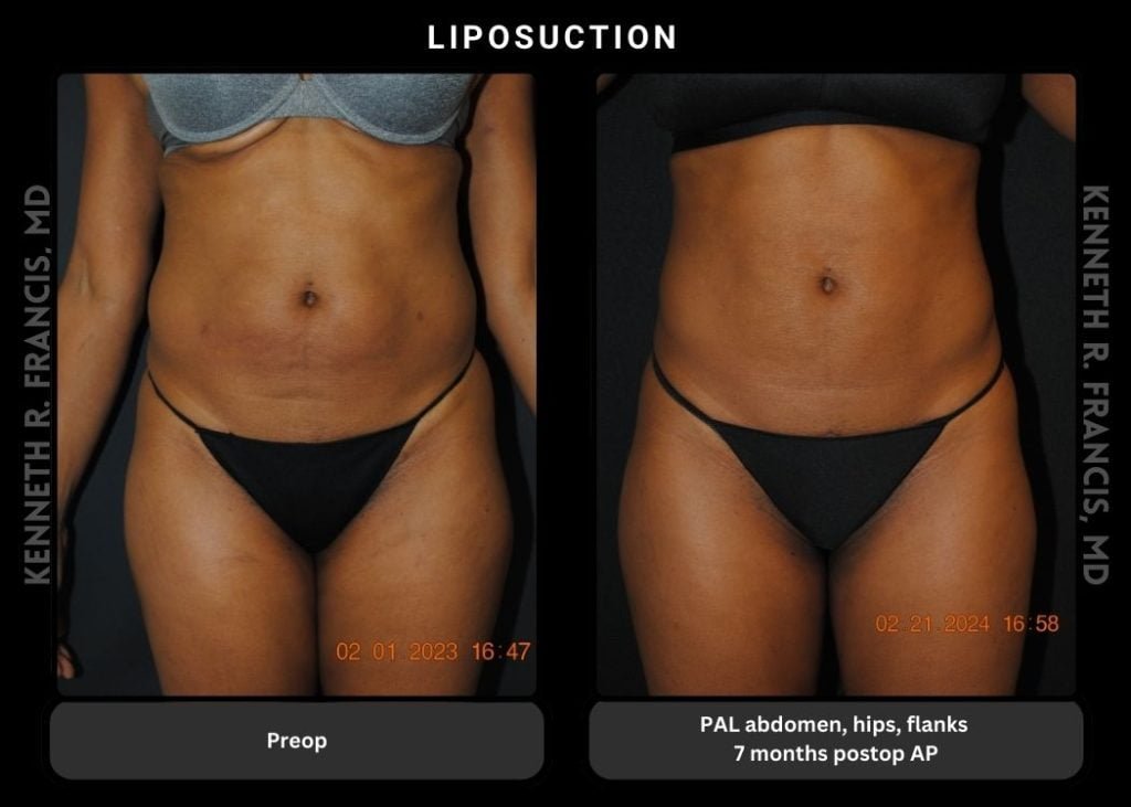 liposuction PAL abdomen hips flanks 7 months postop AP