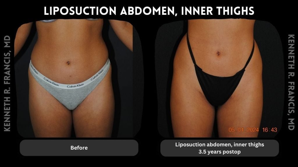 Liposuction abdomen, Flank 3.5 years postop