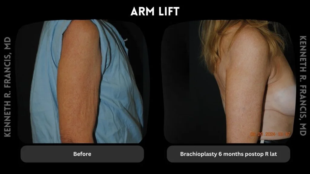Arm Lift Brachioplasty 6 months postop R lat
